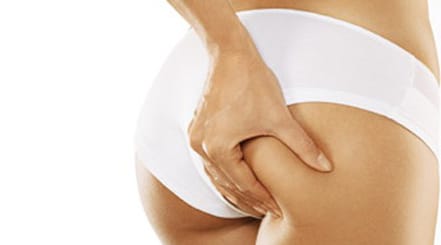 celulitis